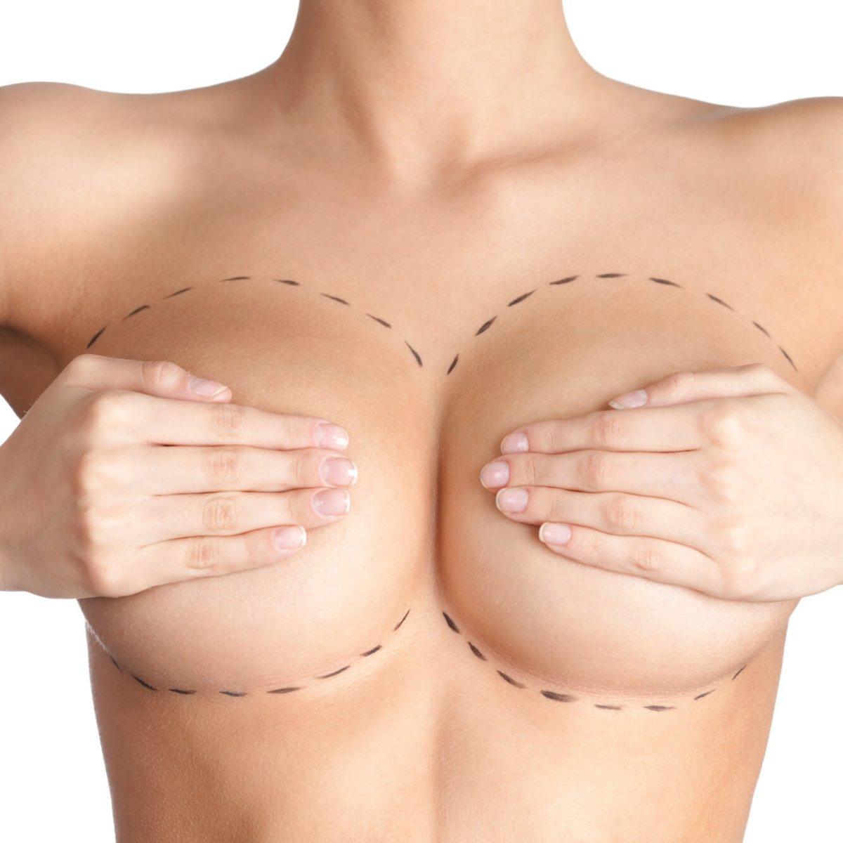 как уменьшить объем груди у женщин фото 35